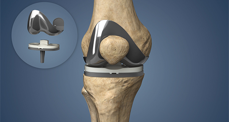 Knee Replacement